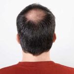 alopecia-androgenica