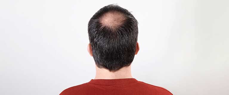 alopecia-androgenica