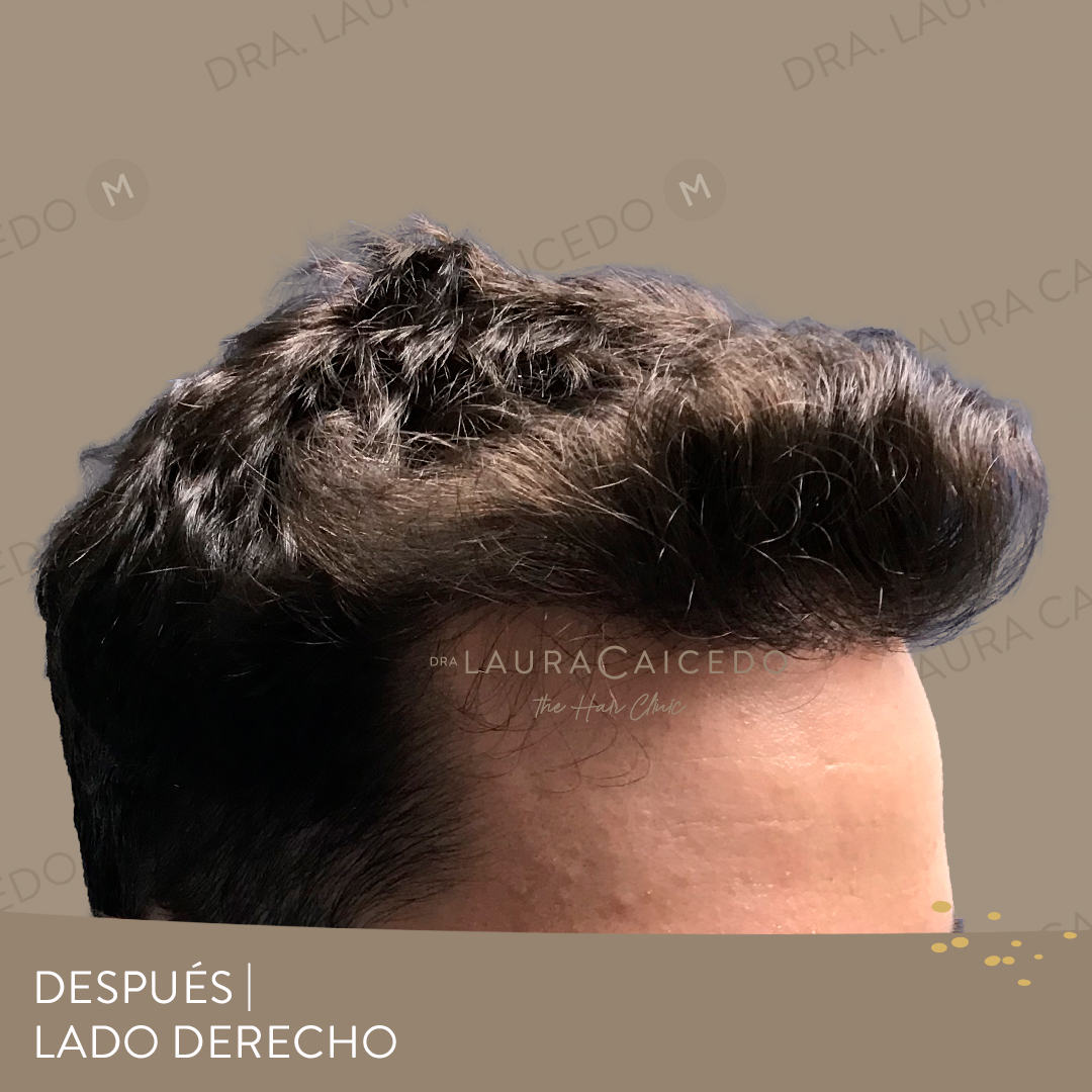 Casos 22 antesdespues 05
