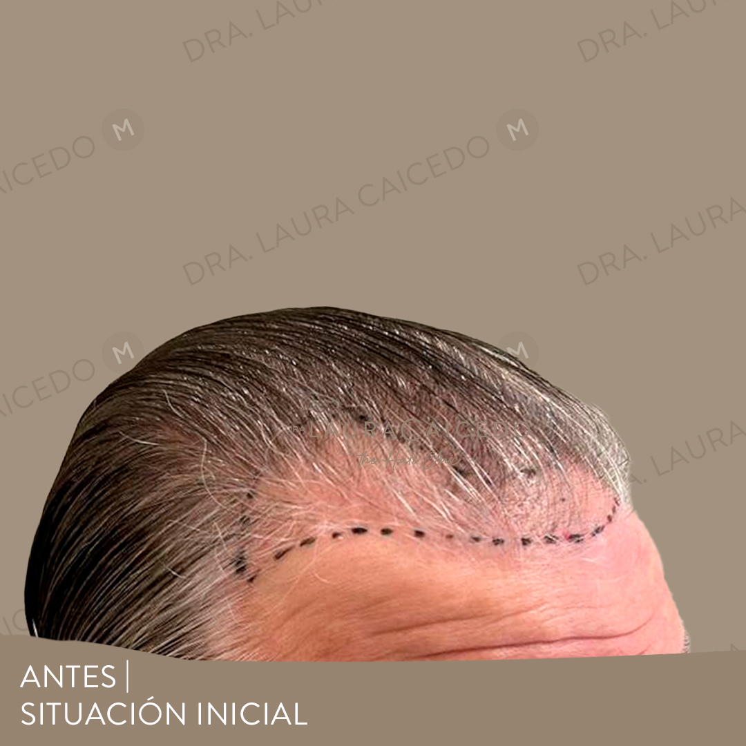 Casos 11 antesdespues 06