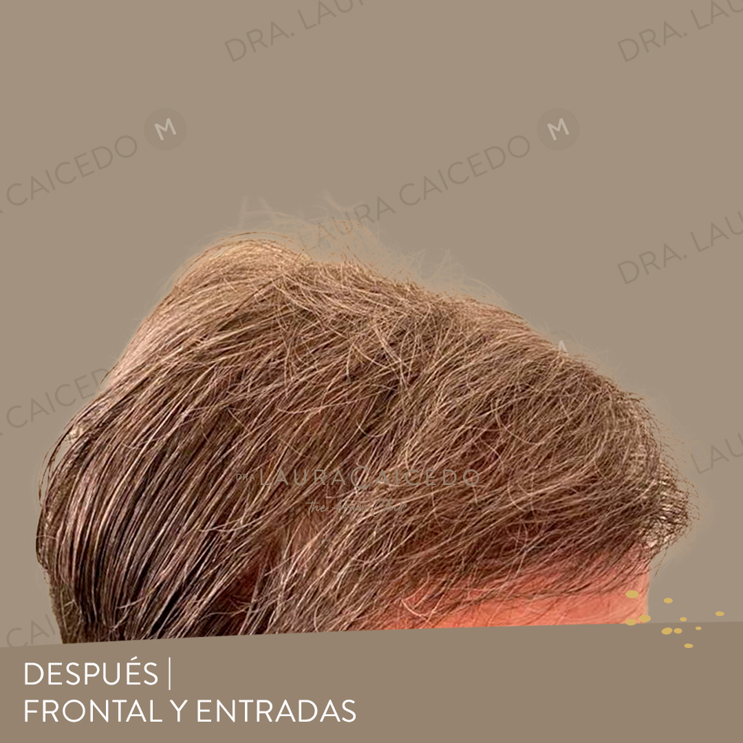 Casos 12 antesdespues 07